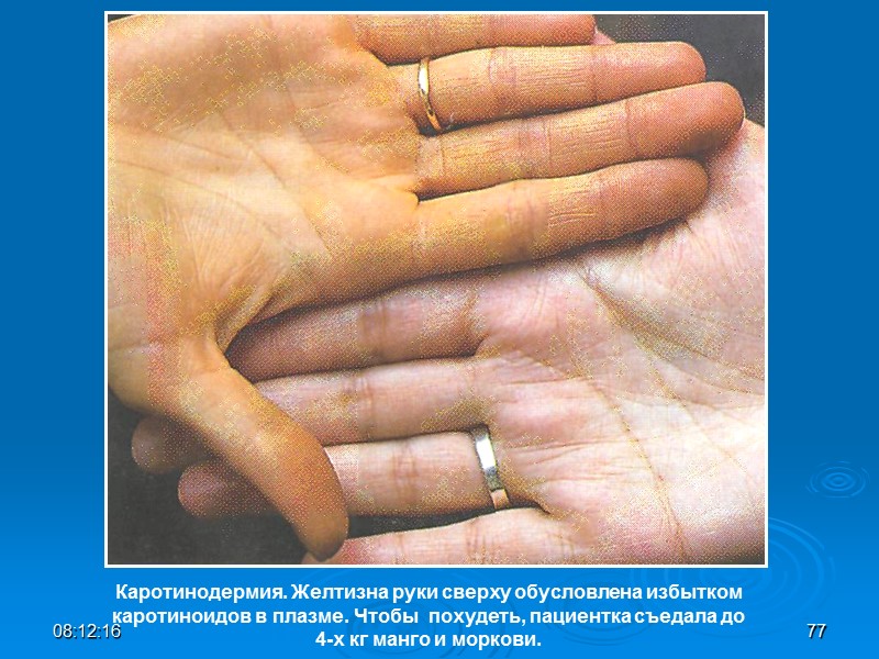 08:12:02 77 Каротинодермия. Желтизна руки сверху обусловлена избытком  каротиноидов в плазме. Чтобы 